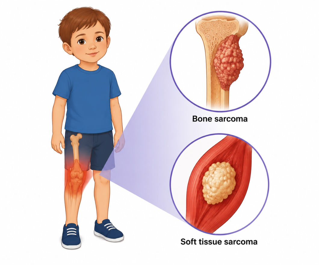 Bone and Soft Tissue Sarcomas Treatment & Care